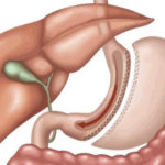 Sleeve-Gastrectomy-Waked