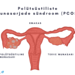 polütsüstilised munasarjad ehk polütsüstiliste munasarjade sündroom PCOS