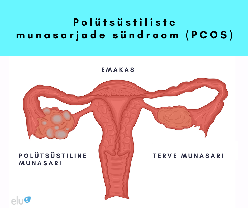 polütsüstilised munasarjad ehk polütsüstiliste munasarjade sündroom PCOS